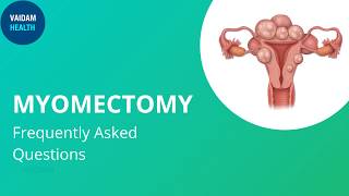 Myomectomy Frequently Asked Questions [upl. by Nidya978]