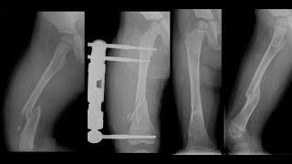 Fractura de fémur  Rehabilitación en casa [upl. by Yllime]