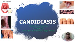 Candidiasis  Candida albicans  Pathogenesis  Clinical Manifestations  Lab Diagnosis  Treatment [upl. by Edlun]