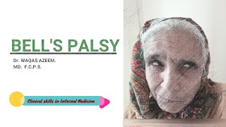 Bells Palsy [upl. by Llerrej]