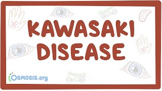 Kawasaki disease  an Osmosis Preview [upl. by Masuh650]