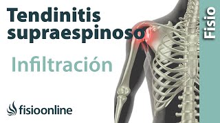 Tendinitis de hombro o supraespinoso infiltraciones [upl. by Yluj]