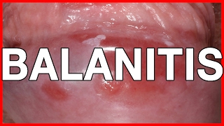 Balanitis Symptoms Causes Treatment and Prevention [upl. by Wyatt]