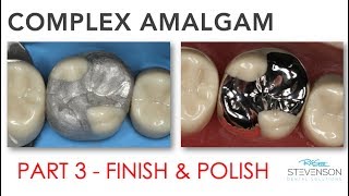 Complex Amalgam  Finishing amp Polishing  Part 3 [upl. by Tippets379]