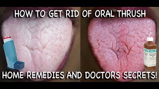 How to Treat Candida at Home Doctors Advice [upl. by Neelyar51]