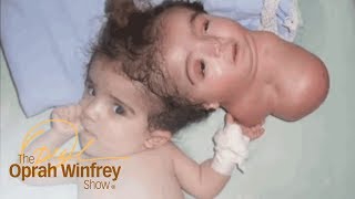 The 2Headed Baby Miracle  The Oprah Winfrey Show  Oprah Winfrey Network [upl. by Mareld]