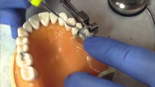 Class II Amalgam Restoration Instructions by Dr Ywom [upl. by Joappa408]