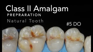 Class II Amalgam Preparation  5 DO Natural Tooth [upl. by Ongun646]