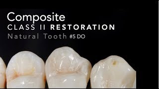 Class II Composite Restoration  5 DO Natural Tooth [upl. by Hana]