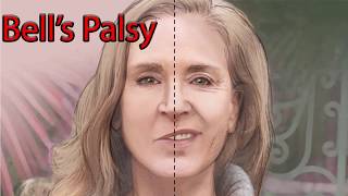 Bells Palsy Explained Clearly  Exam Practice Question [upl. by Egiap246]