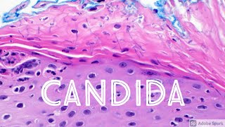 Candida Yeast Infection under microscope Candidiasis Dermatology Dermatopathology [upl. by Hare125]